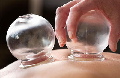 Umesh Bansal Physiotherapy cupping